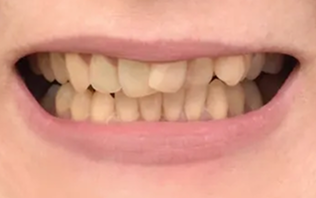 Crooked teeth