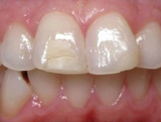 Discolored enamel on front tooth